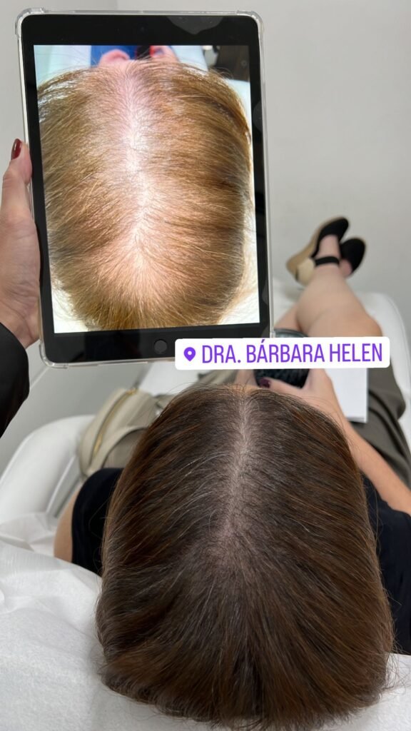 Tratamento para calvice e queda capilar alopecia e cabelos quebradicos